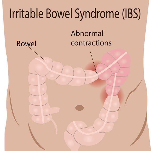 Patient Testimonial for Natural Remedies for Irritable Bowel Syndrome (IBS) by Board-Certified Nutritional Specialist via Telehealth and from Forest Hills NY 11375
