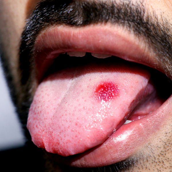 Man with Symptoms of Lichen Planus on his tongue