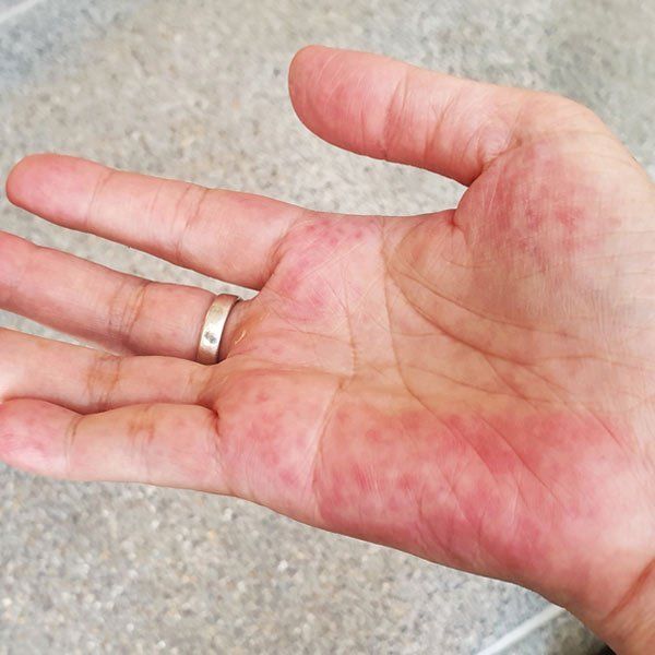 Woman with Lupus Symptoms on her hand
