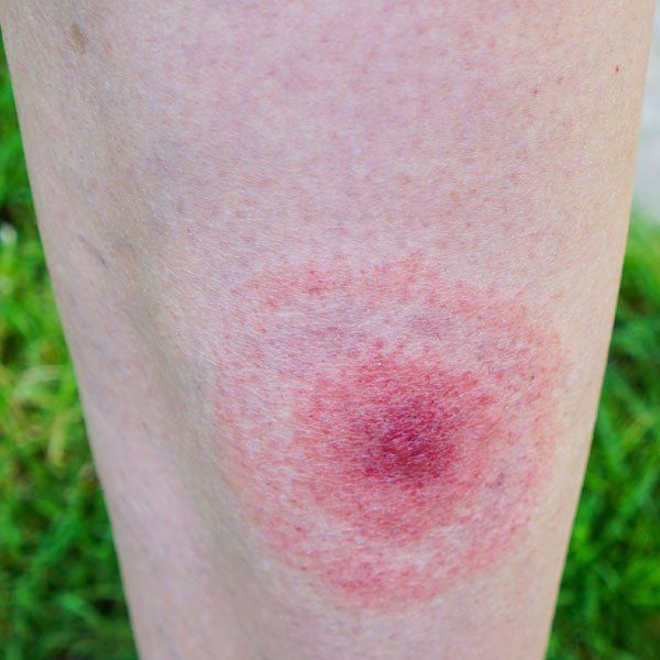 Woman with Lyme Disease has the classic rash from a tick bite