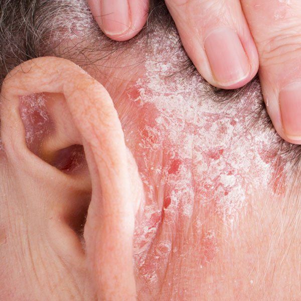 Woman with Psoriasis behind her ear