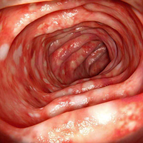 Closeup of Large intestine with Ulcerative Colitis (UC)
