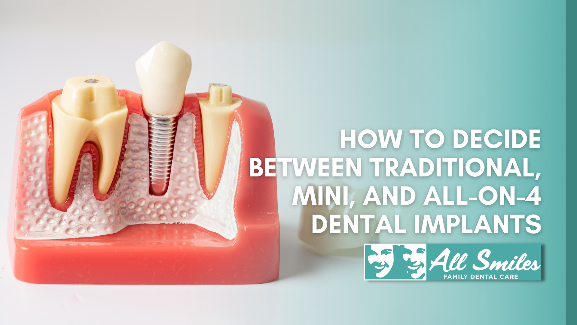 How to decide between traditional , mini , and all-on-4 dental implants