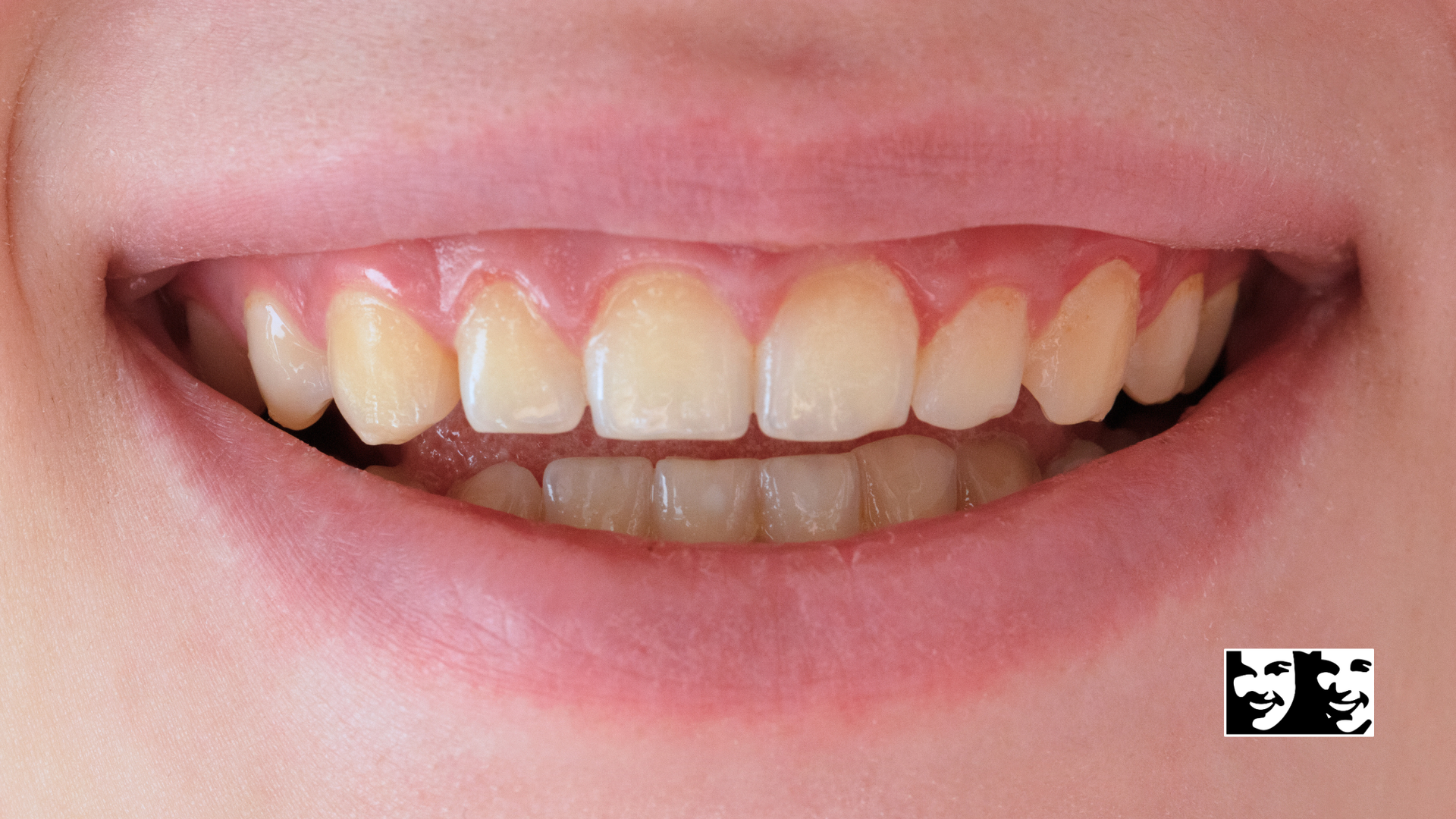 A close up of a person 's mouth with white teeth.