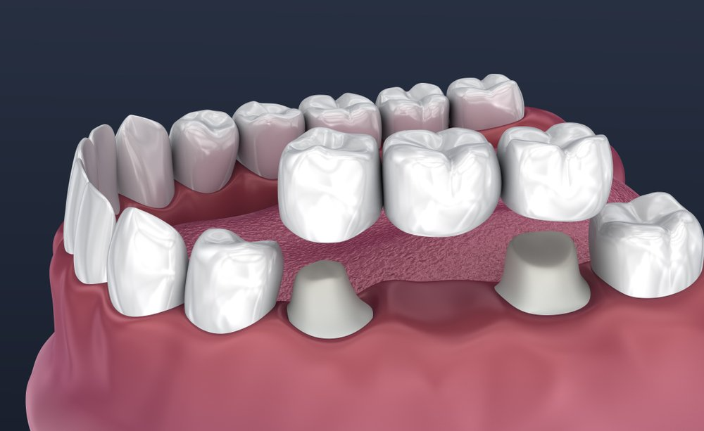 traditional fixed dental bridge | dentist near you | All Smiles Dentistry | Dentist in Lake Jackson, Texas