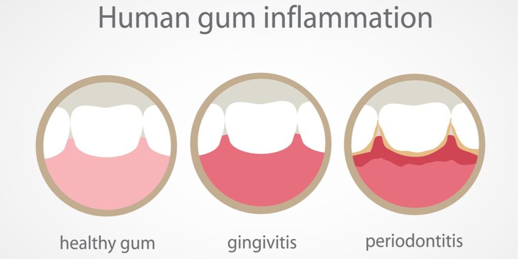 Effects on the Gums