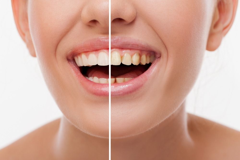 Before and After Dental Stains 2 - All Smiles Dentistry