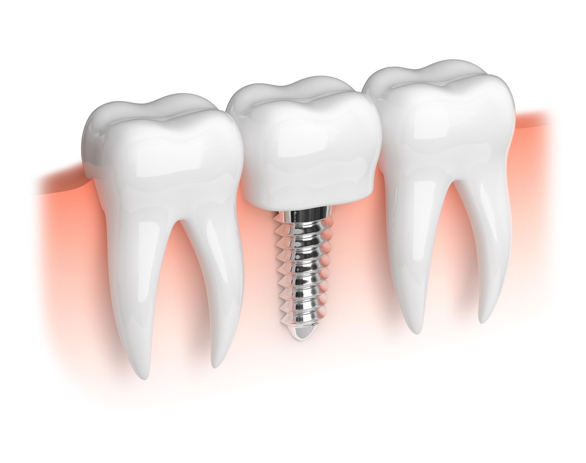 Implants. Model of teeth and dental implant - All Smiles Dentistry