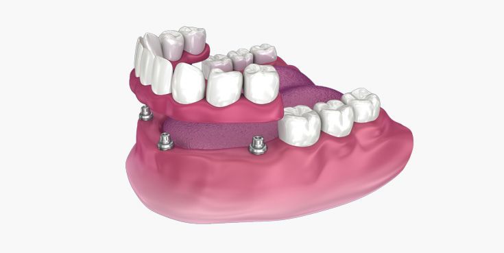 implant Supported Denture