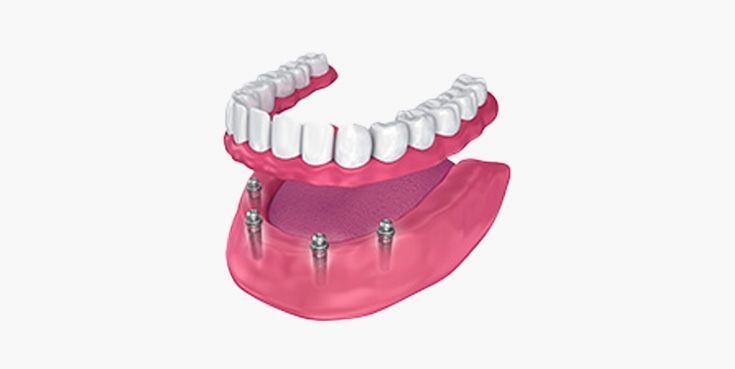 Implant Retained Dentrue