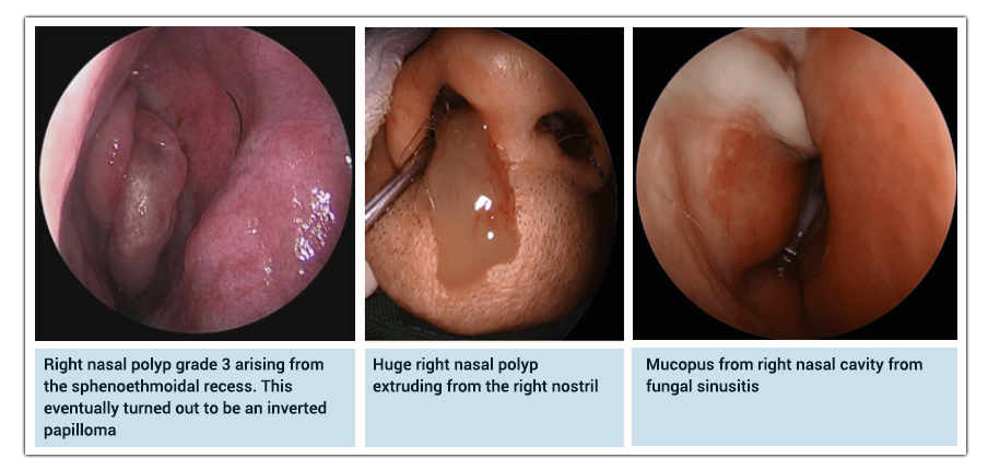 inverted papilloma vs nasal polyp