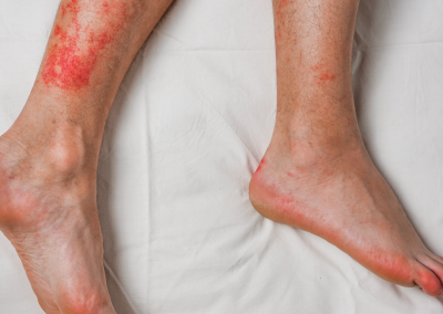 Pictures of Bed Bug Bites