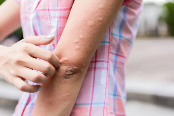 A woman is scratching her arm with mosquito bites.