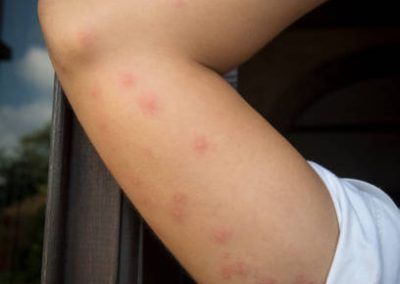Pictures of Bed Bug Bites