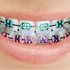 closeup image of braces with color elastics
