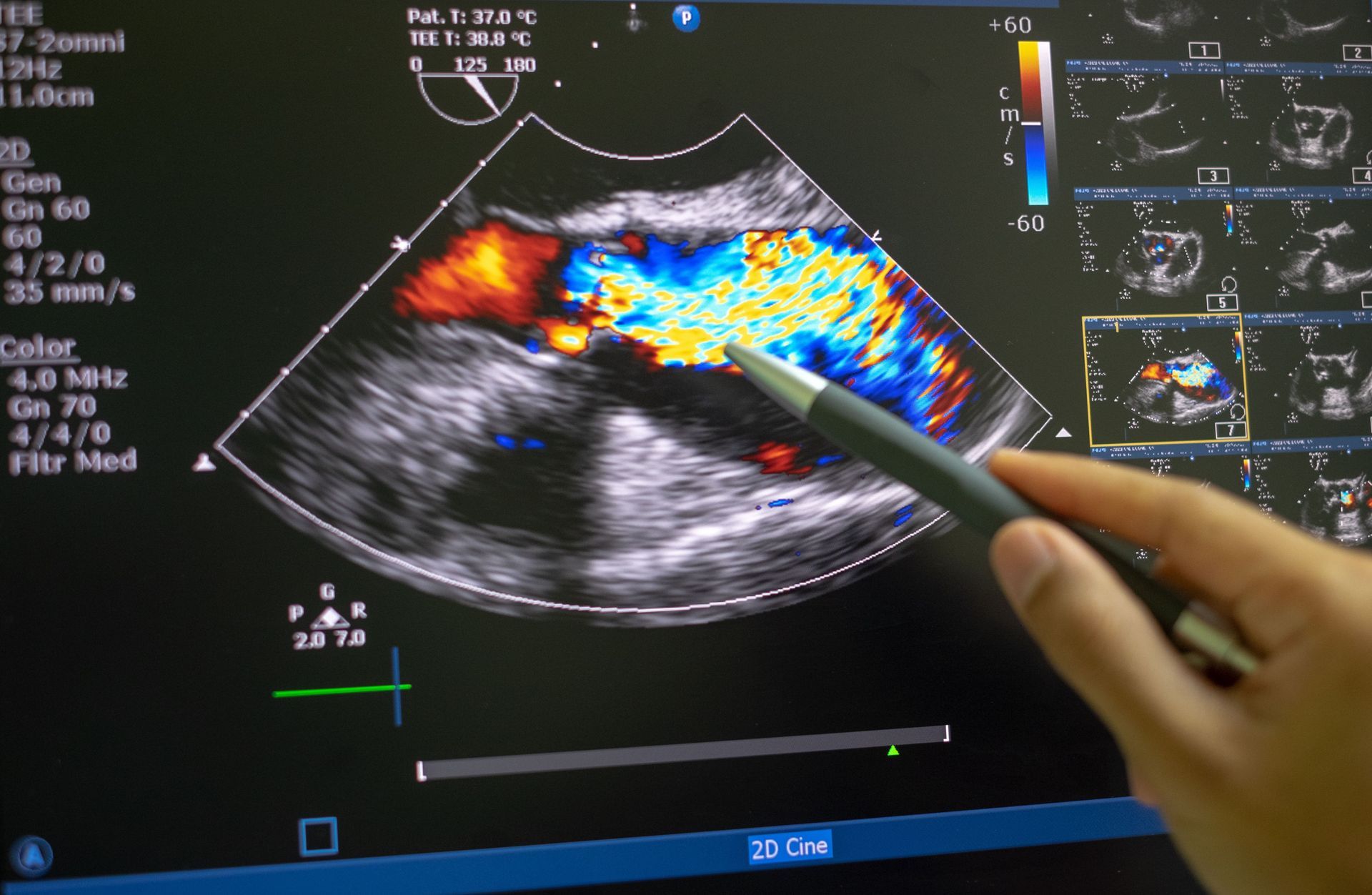 Ultrassonografia e Ultrassonografia com doppler colorido