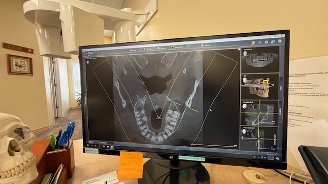A computer monitor is displaying a dental x-ray of a person 's teeth.