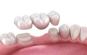 A computer generated image of a dental bridge in a person 's mouth.