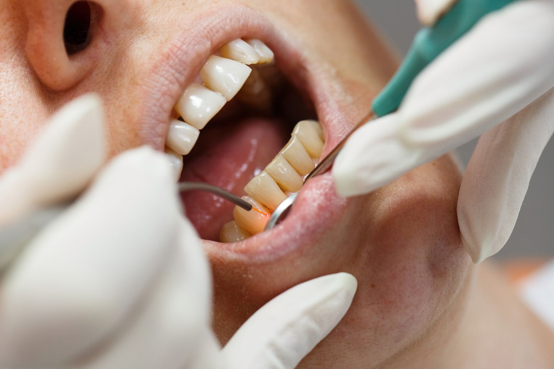 A man is getting his teeth examined by a dentist.
