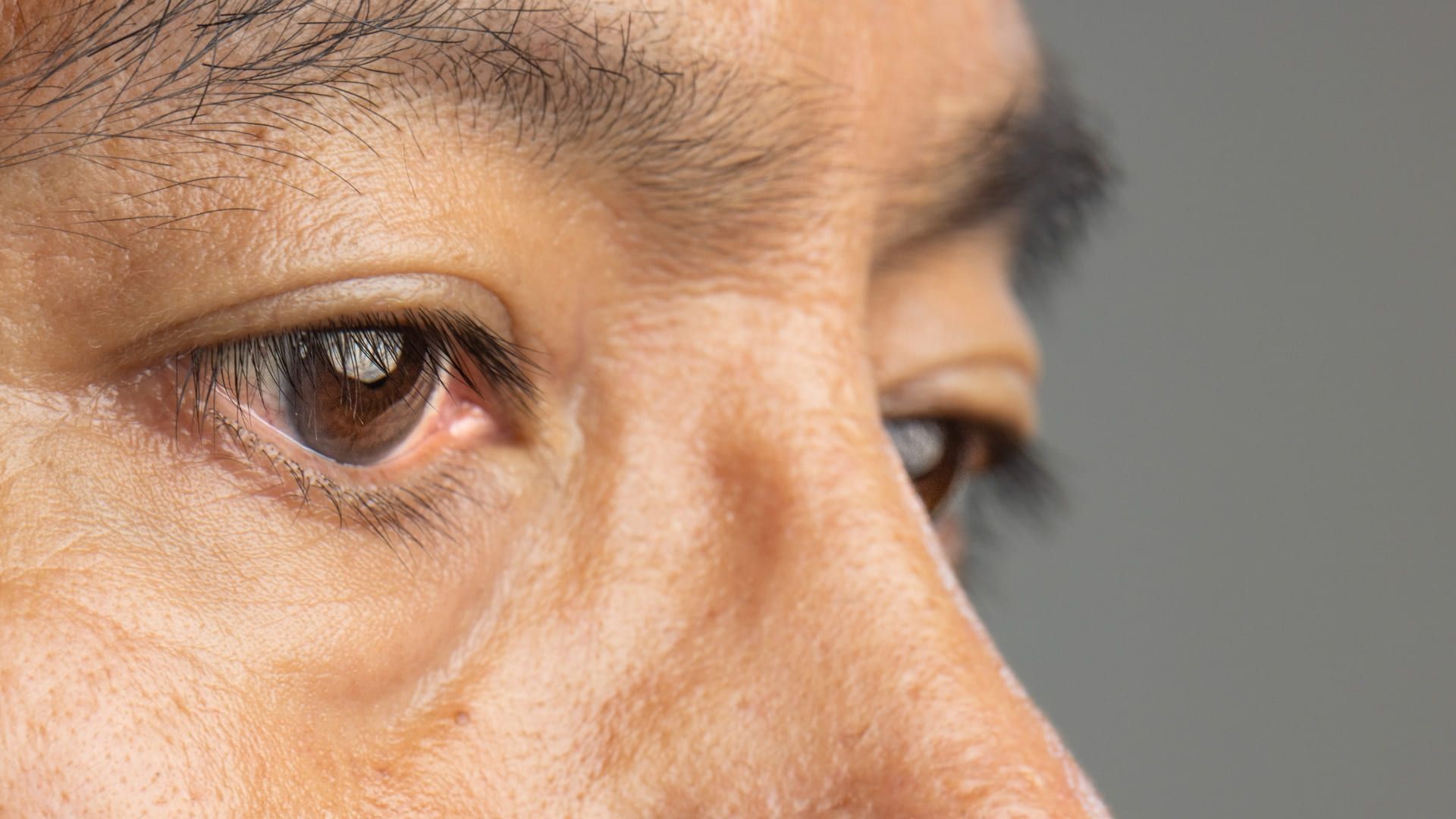 A close-up on a diabetic man's eyes.