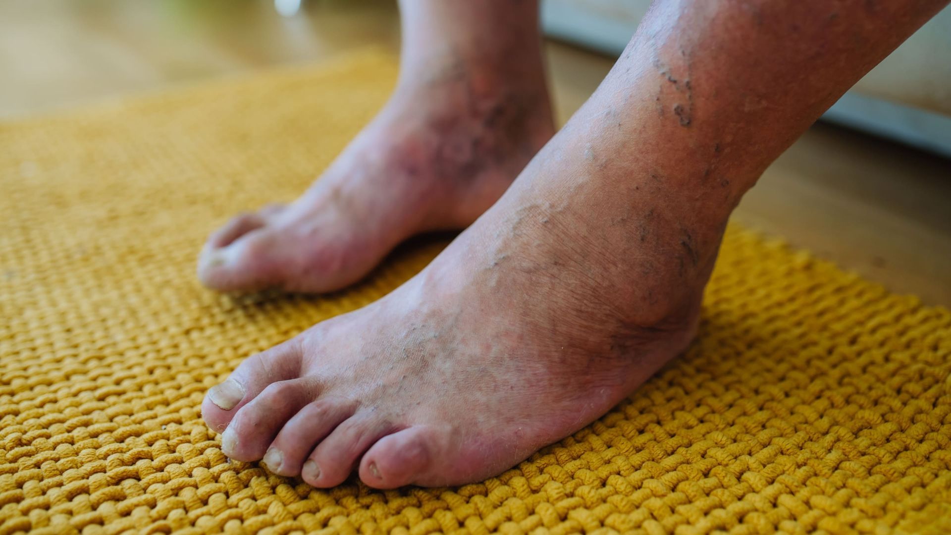 A picture of a diabetic person's feet with complications.
