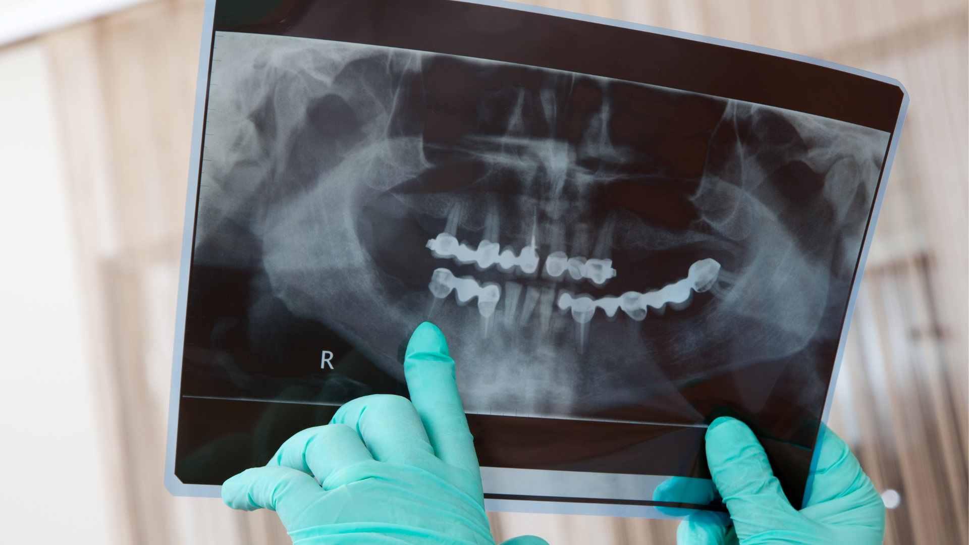 Hands in green gloves holding and pointing at a dental X-ray of teeth.