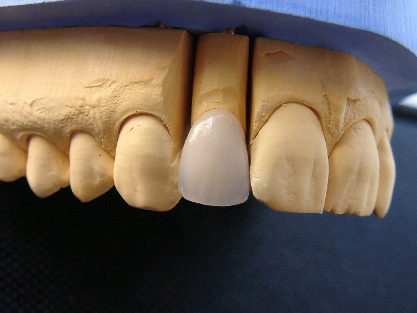 Ein Modell der Zähne einer Person mit einem weißen Zahn in der Mitte