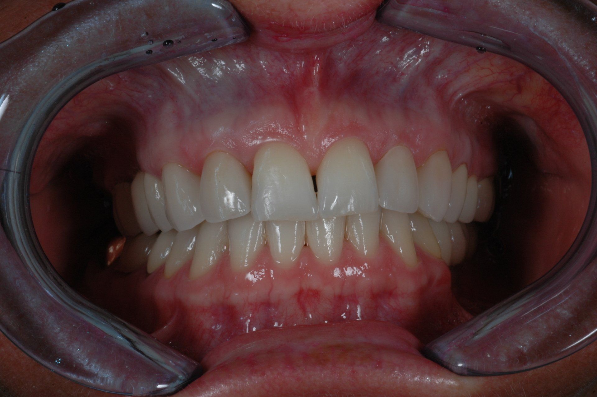 Eine Nahaufnahme der Zähne einer Person mit Mundschutz.