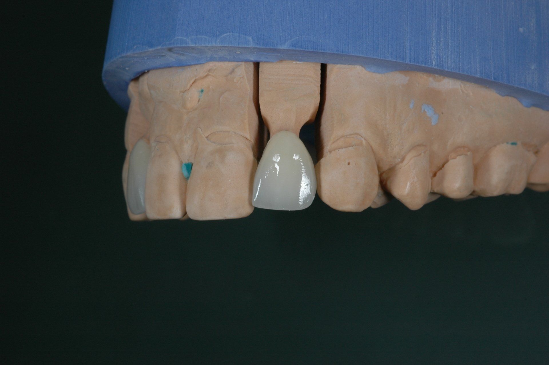 Eine Nahaufnahme eines Modells menschlicher Zähne mit einer Zahnkrone.