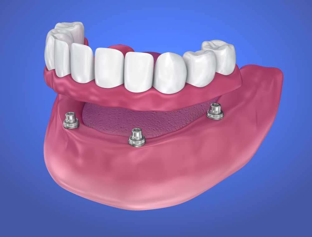 A 3D Rendering Of A Full Denture With Dental Implants — Mittagong Dental Care In Mittagong, NSW