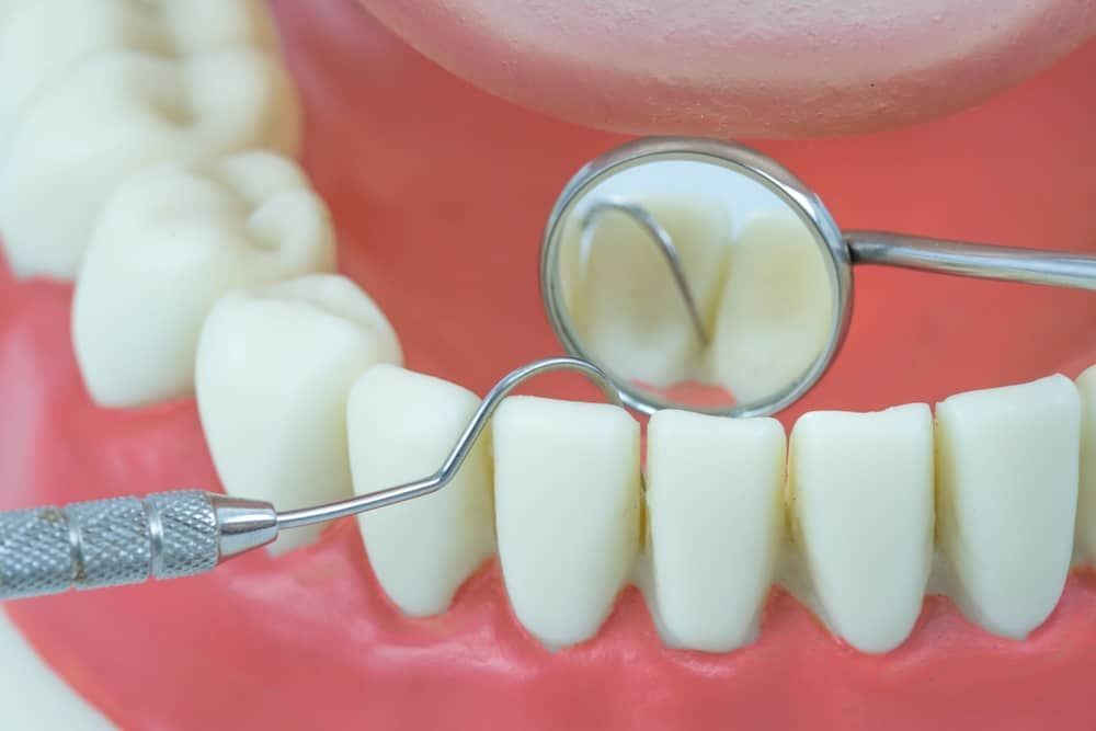A Close Up Of A Person 's Teeth — Mittagong Dental Care In Mittagong, NSW