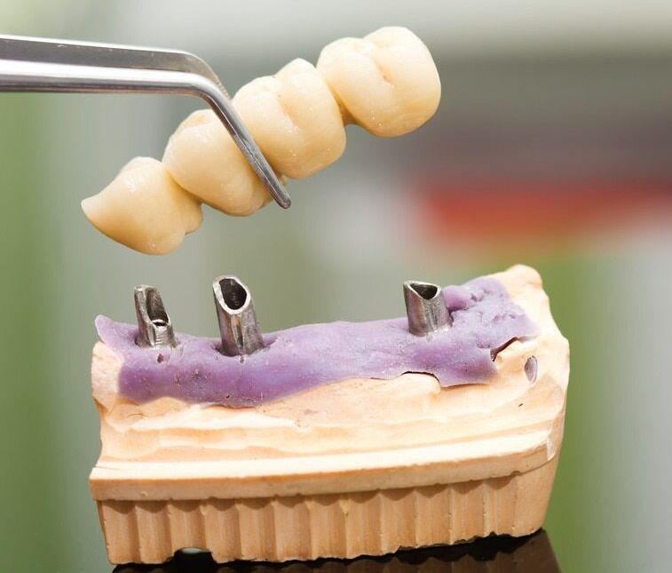 A Dental Bridge Is Being Built On A Model Of A Tooth — Mittagong Dental Care In Mittagong, NSW