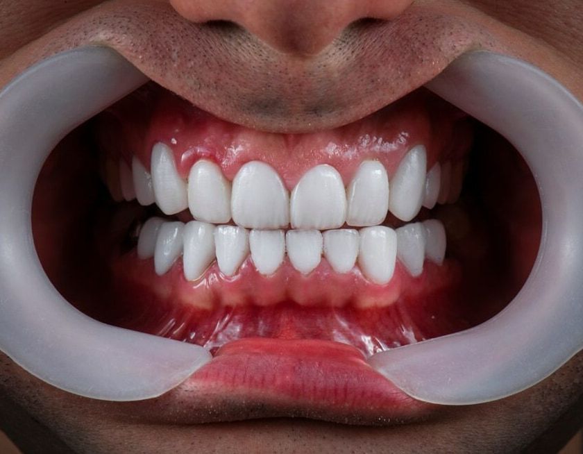 A Close Up Of A Man's Mouth With White Teeth And A Mouth Guard — Mittagong Dental Care In Mittagong, NSW