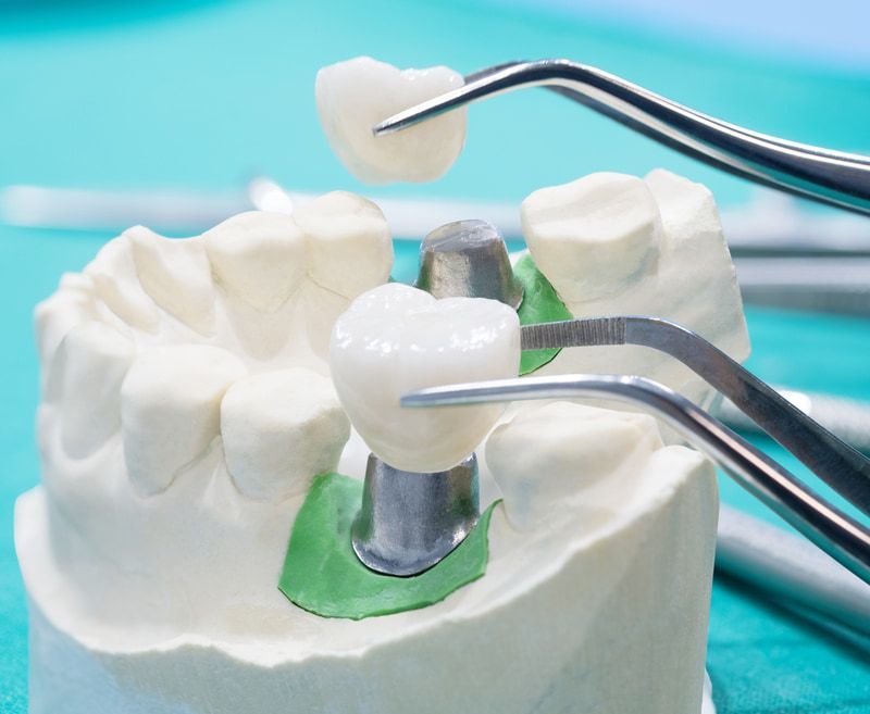 A Model Of A Tooth With A Crown Being Placed On It — Mittagong Dental Care In Mittagong, NSW