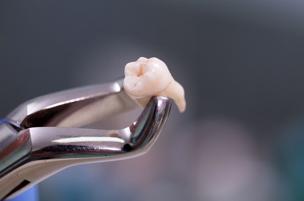 A Close Up Of A Tooth Being Extracted With Dental Pliers — Mittagong Dental Care In Mittagong, NSW
