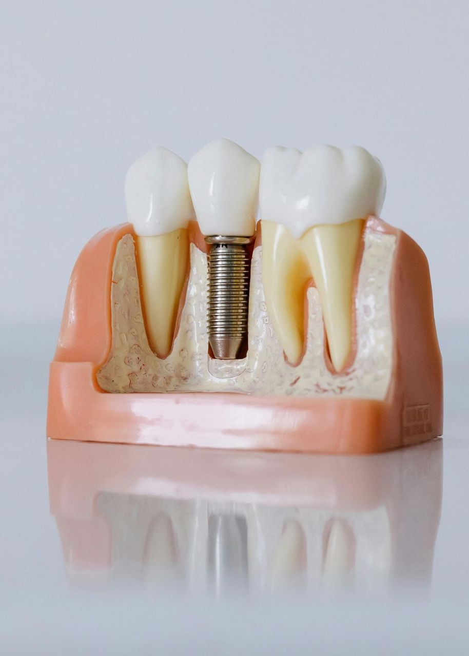 A Model Of A Tooth With A Dental Implant In It — Mittagong Dental Care In Mittagong, NSW