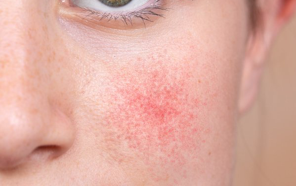 Um close do rosto de uma mulher com manchas vermelhas.