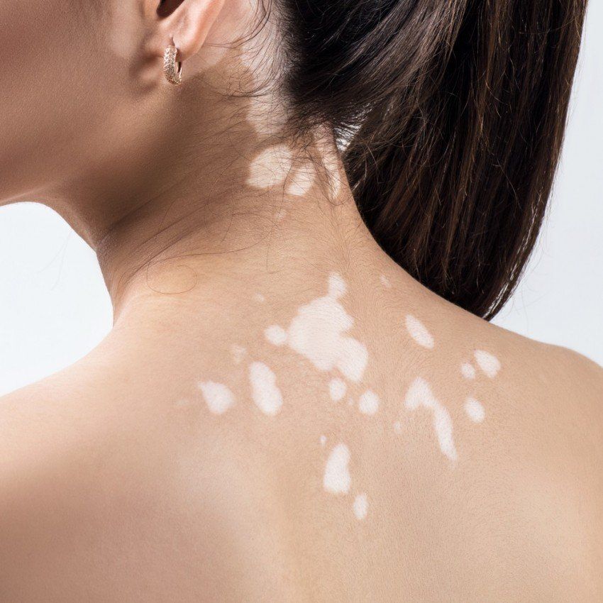 As costas de uma mulher com manchas brancas na pele.