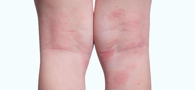 Um close do joelho de uma pessoa com manchas vermelhas.