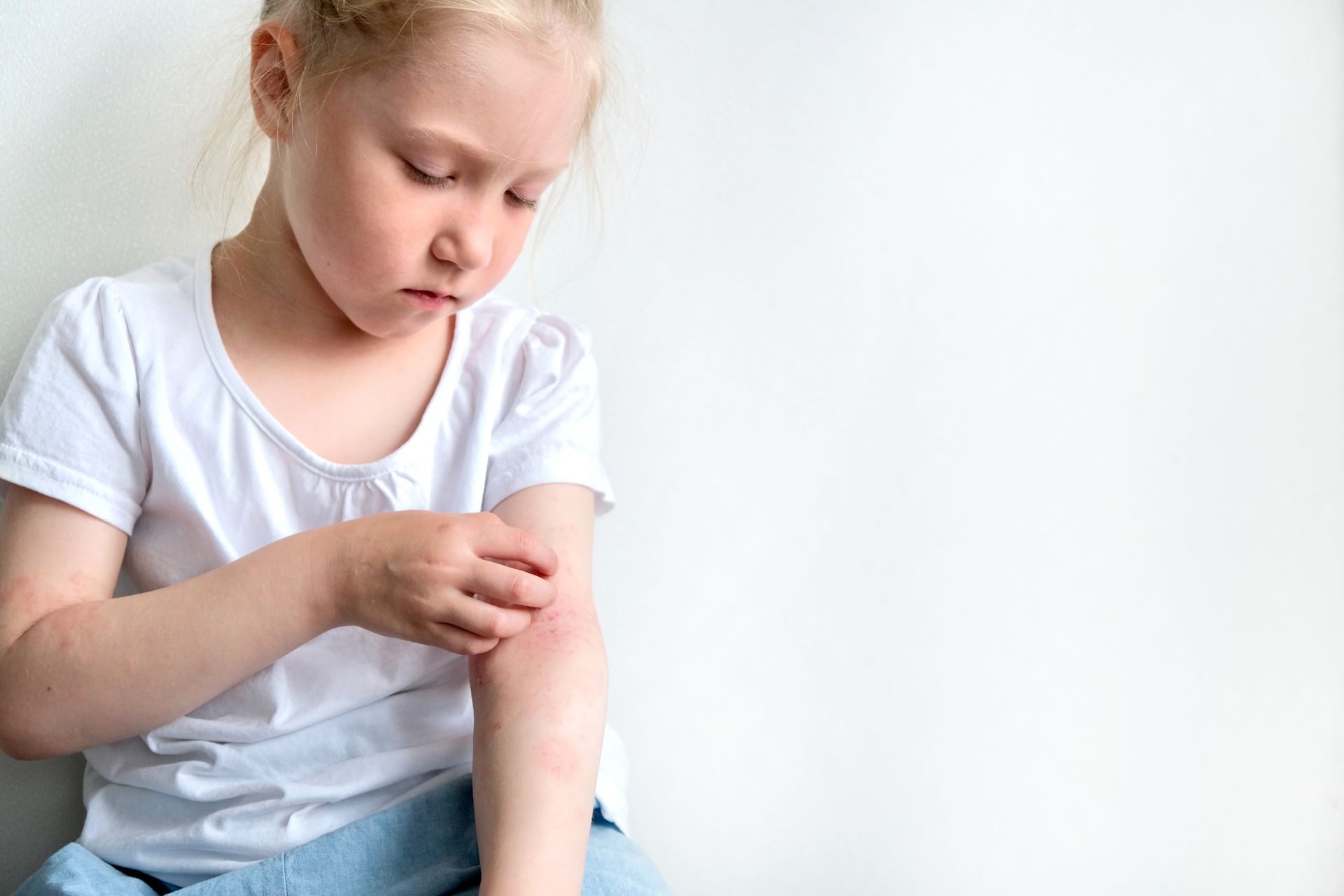 dermatite atópica em crianças