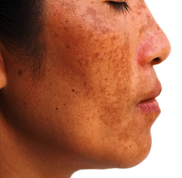 Um close do rosto de uma mulher com manchas marrons