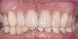 Dentures & partial dentures after — Dental Office in Virginia Beach, VA