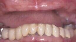 Dentures & Partial dentures before — Dental Office in Virginia Beach, VA