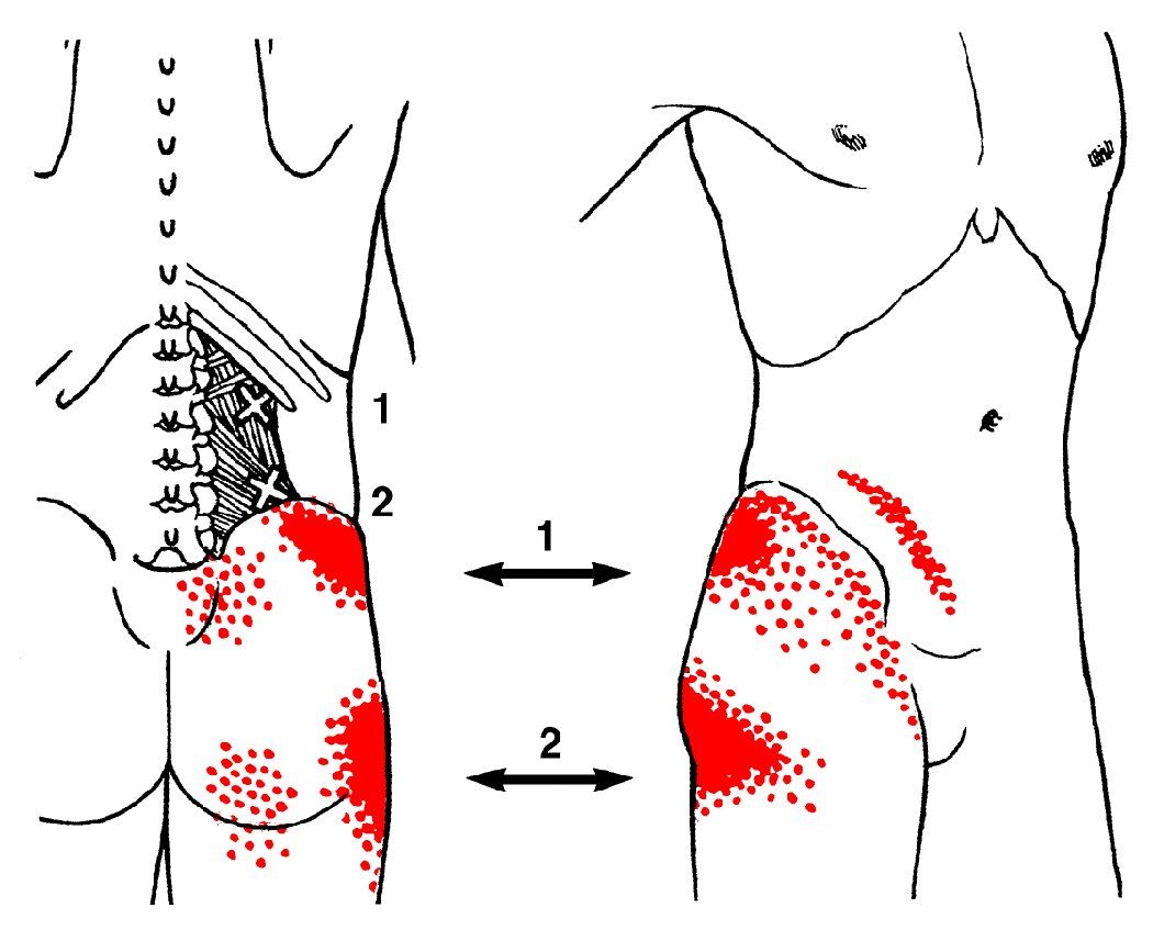 A drawing of a person 's back with red spots on it