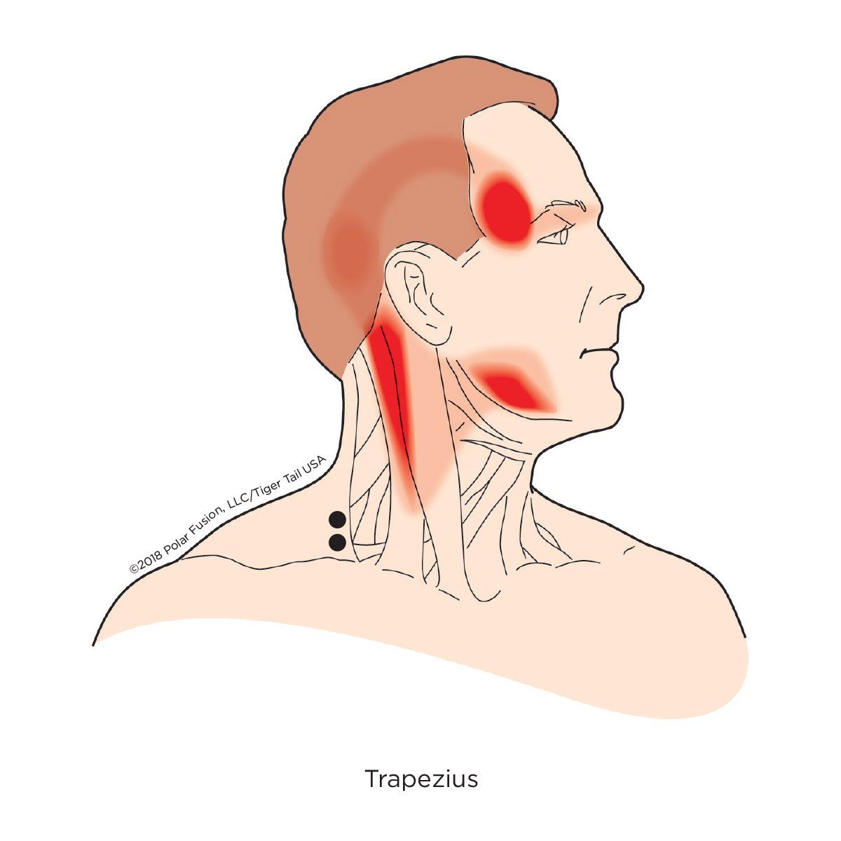 A drawing of a man 's neck with red spots on it
