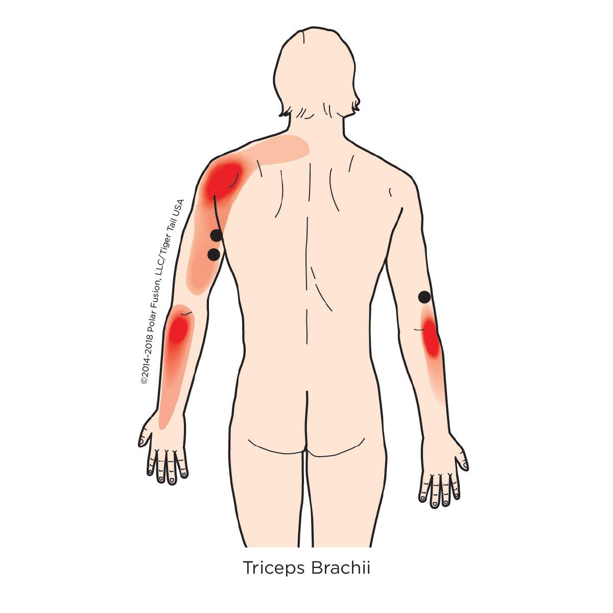 A drawing of a person 's back with red spots on it.