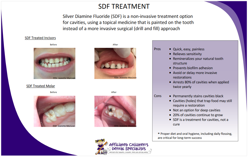 SDF Treatment ─ Flossmoor, IL ─ Pediatric Dental Specialty Associates