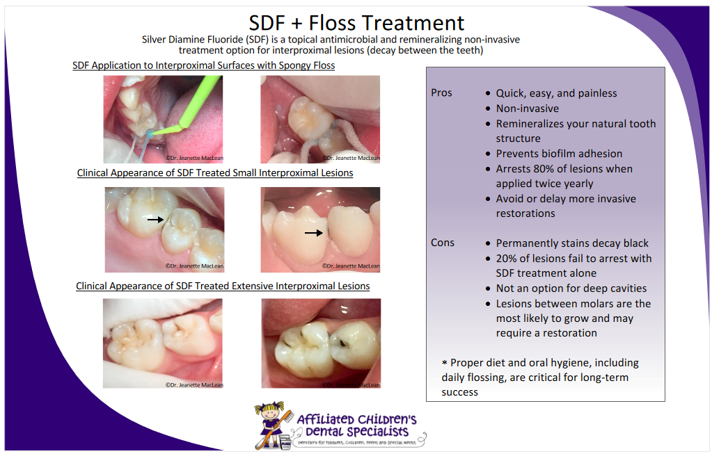 SDF And Floss Treatment ─ Flossmoor, IL ─ Pediatric Dental Specialty Associates