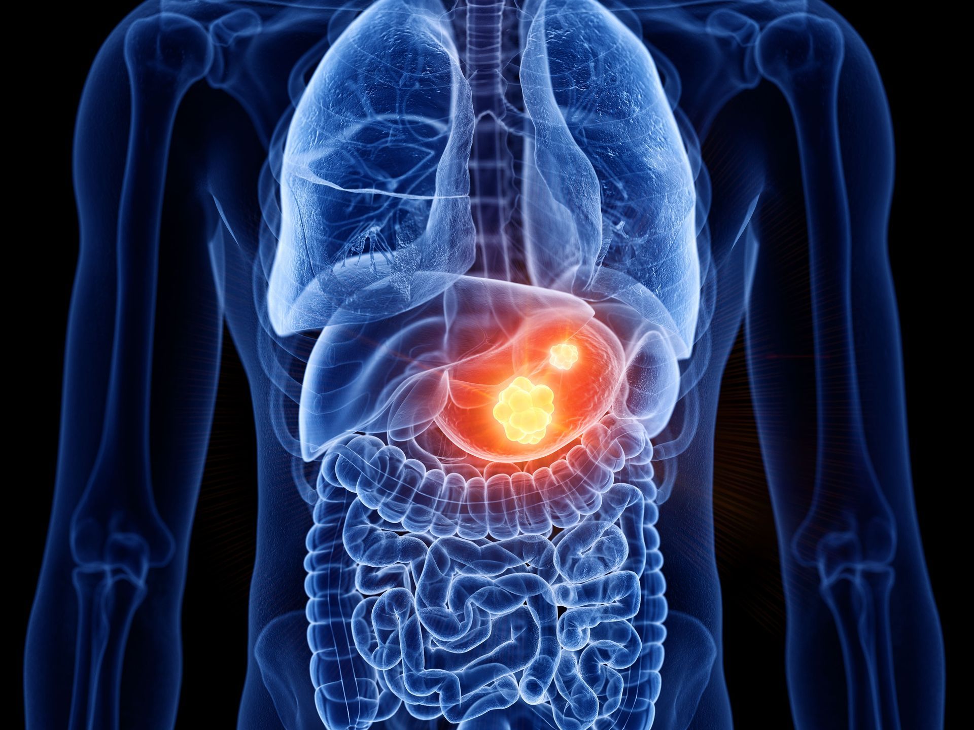 A computer generated image of a person 's stomach with a tumor in it.