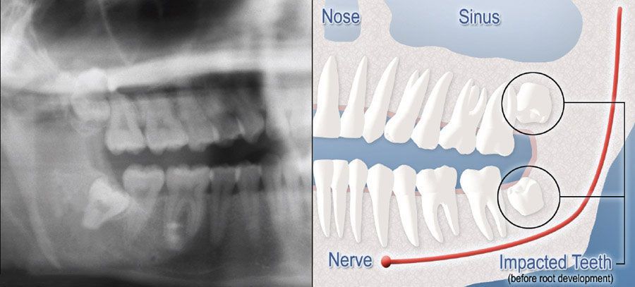 An x-ray of a person 's teeth next to a diagram showing the impacted teeth